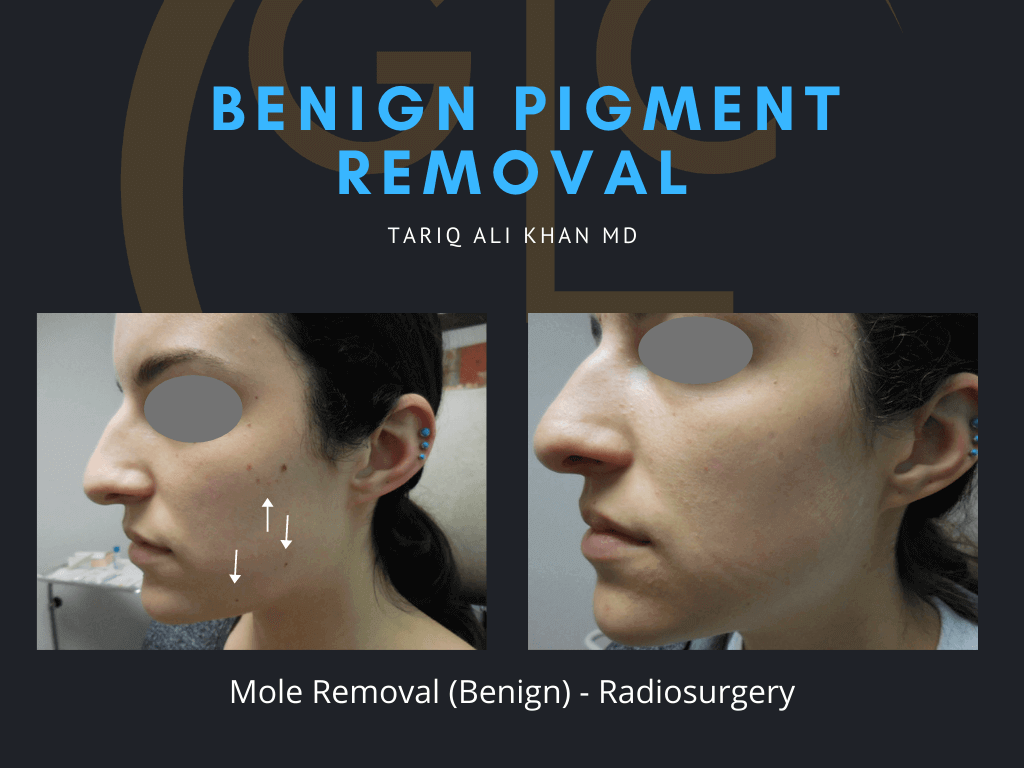 Gentle Care Laser Tustin Before and After picture - Mole Removal